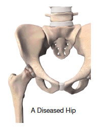 Total Hip Joint Replacement in El Paso TX