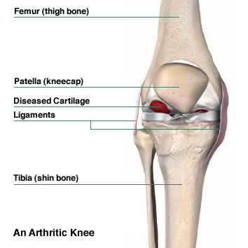 Total Hip Joint Replacement in El Paso TX