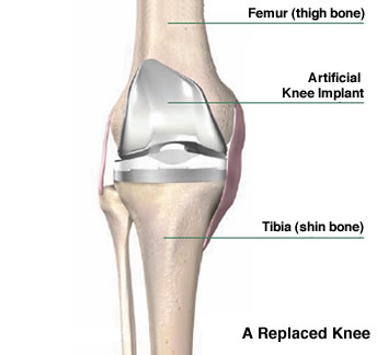 Total Hip Joint Replacement in El Paso TX