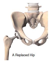 Total Hip Joint Replacement in El Paso TX